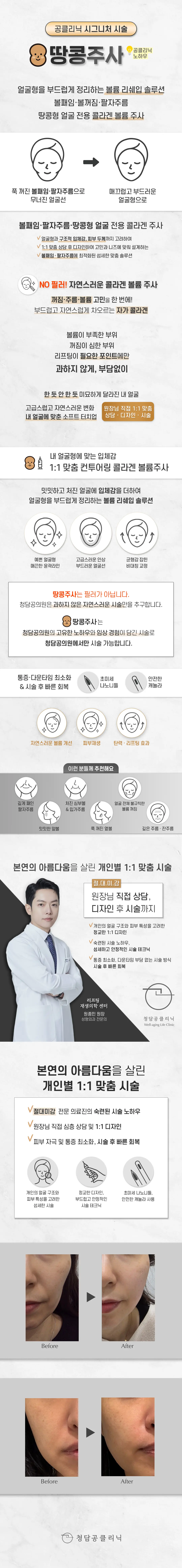 땅콩주사